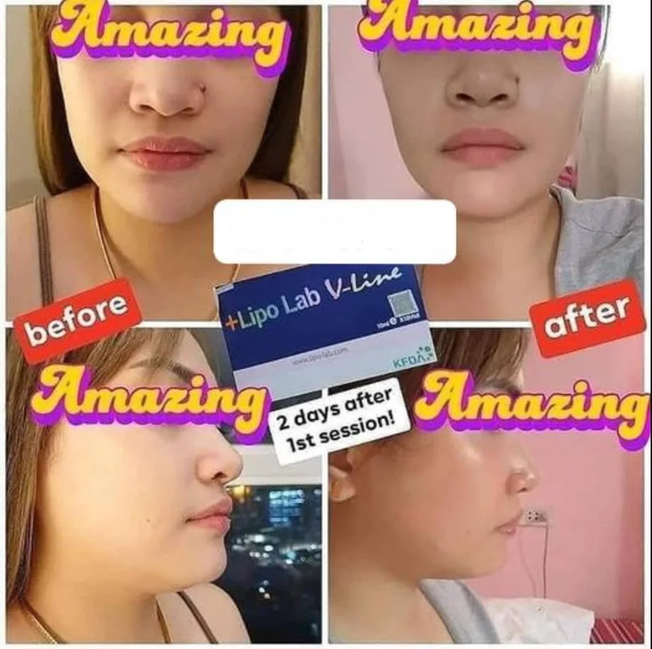 2020 مختبر Lipo Vline جديد ، سلامة عالية ، تأثير سريع ، تأثيرات جانبية صغيرة ، تشكيل سريع للحقن لحل حل الدهون خط الفك