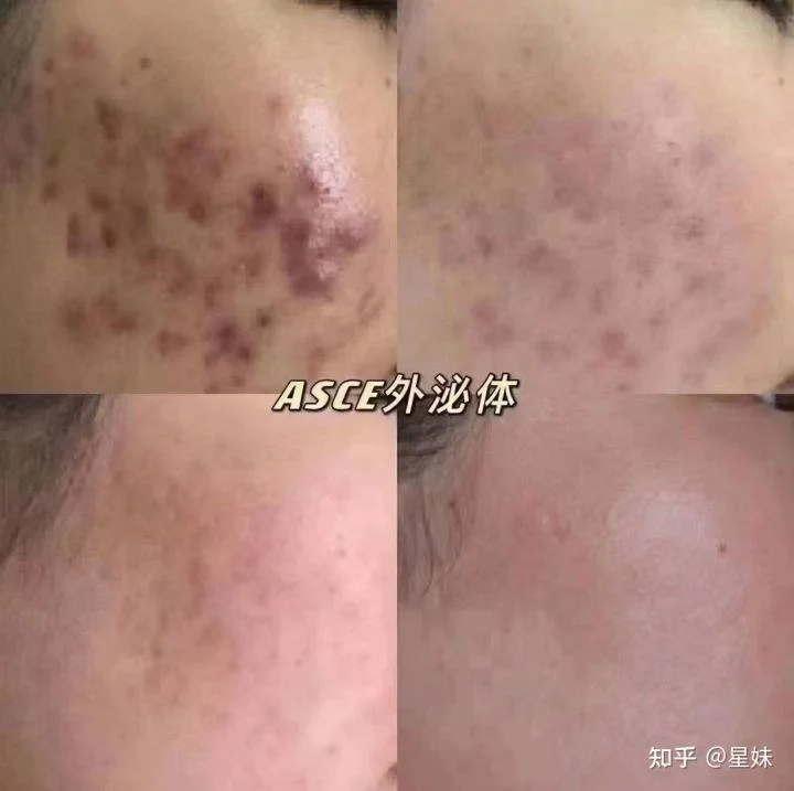 Cytocare 715 + Asce Plus Derma Signal Kit Srlv-S Human Stem Exsome, Best Effect for Skin Firming, Lifting, Anti-Aging, Results Are Immediately Visible