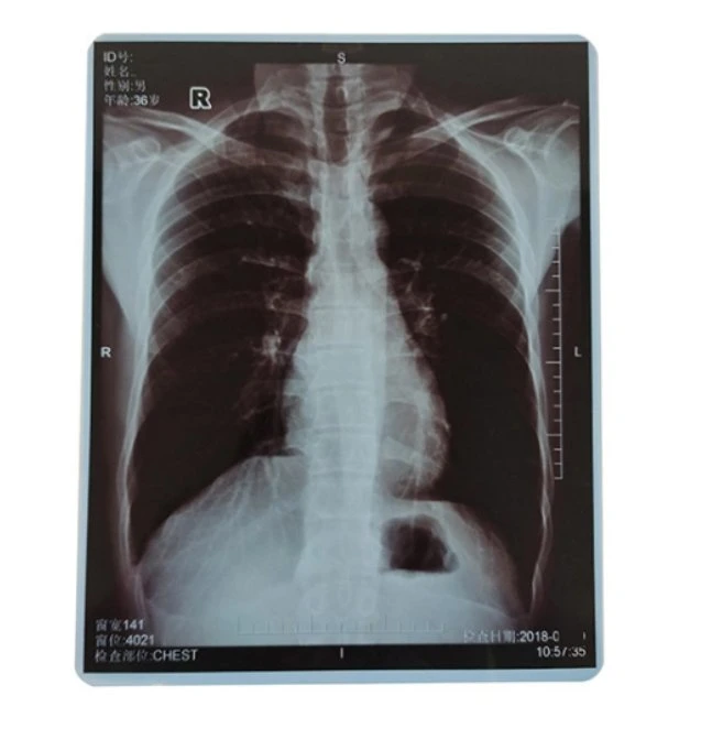 Disposable High quality/High cost performance Blue Film White and Blue Based Laser Print Medical Dry X-ray Film