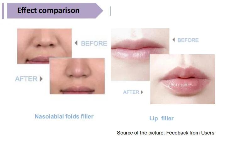 China Transparent Singderm Cross-Linked Hyaluronate Acid Gel Beauty Products Lip Filler