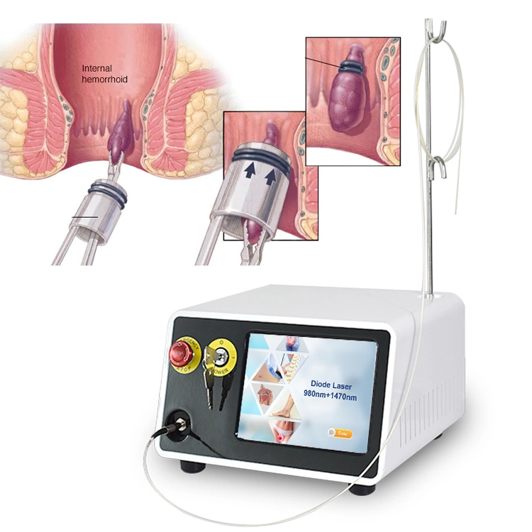 Hemorrhoidectomy Medical Surgery Laser 980nm 1470nm Hemorrhoids Treatment Surgery Anal Fistula Device