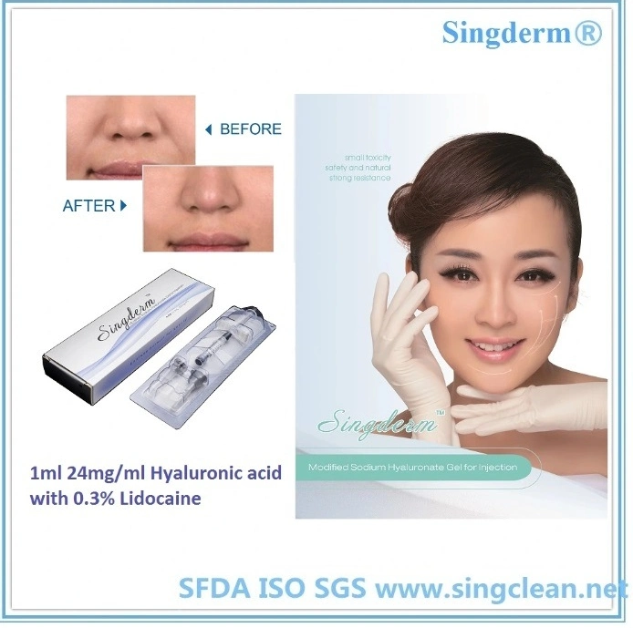 Singderm Lidocain Hyaluronsäure Filler Gel Implantat zum Entfernen von Falten Plastische Chirurgie