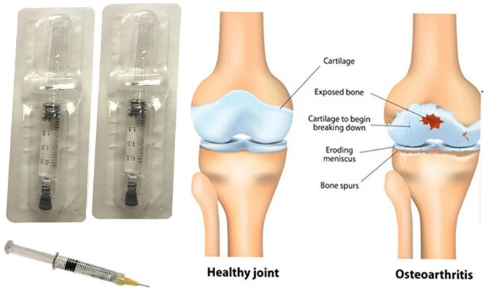 Singjoint Quickclean Ha Medical Sodium Hyaluronate Gel for Orthopedics Surgery Injection