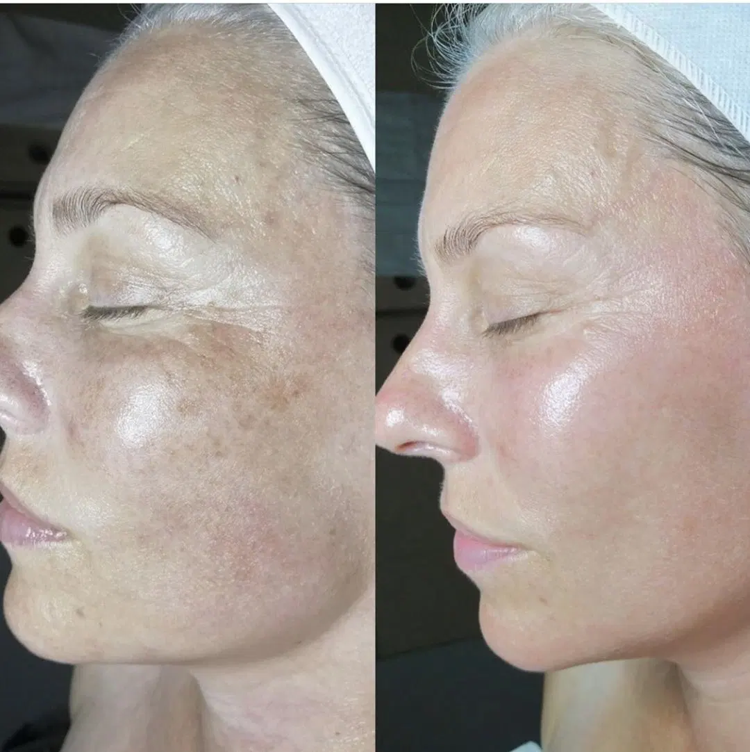 Salon de beauté Accueil utilisé Otesaly Prix de gros solution de blanchiment de la peau Otesaly Mesothérapie sérum pour les taches d'âge pigmentation Freckles