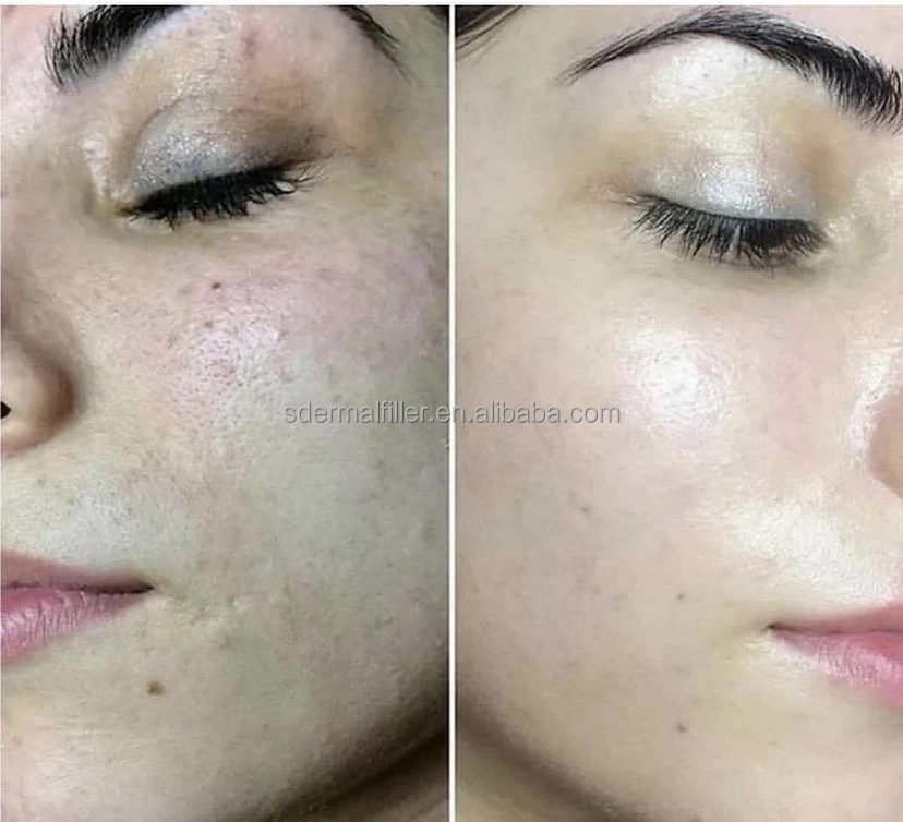 Beauty Salon Home Used Otesaly Wholesale/Supplier Price Skin Whitening Solution Otesaly Mesotherapy Serum for Age Spots Freckles Pigmentation