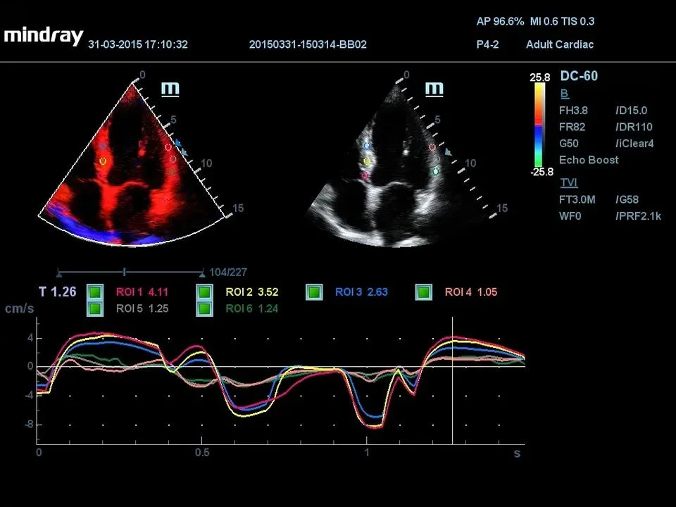 Mindray DC-60 3D/4D Color Doppler Ultrasound Machine