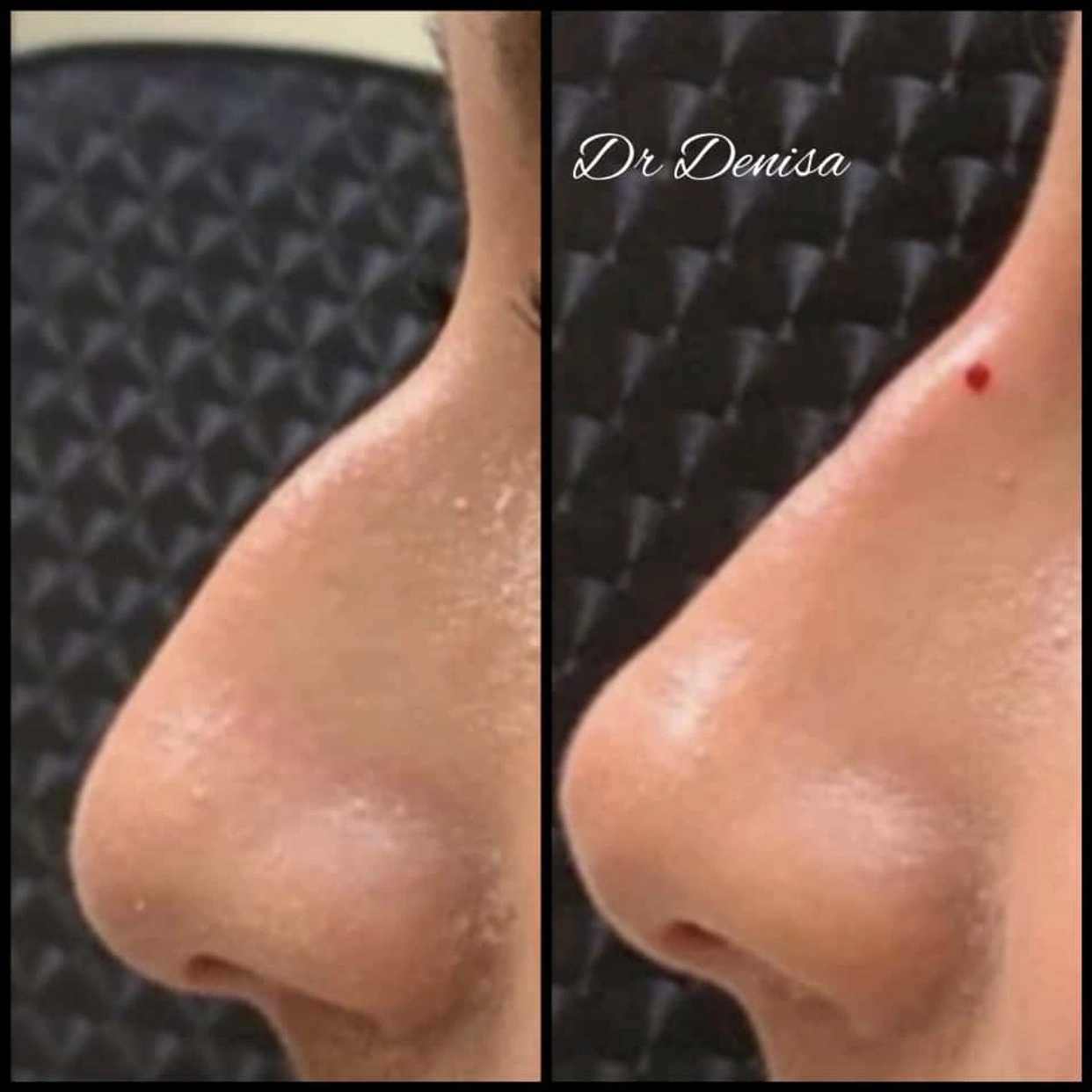 Otesaly 1ml Hyaluronsäure Tiefe Linien Dermal Filler Cross Linked Injektion Der Gesichtshaut