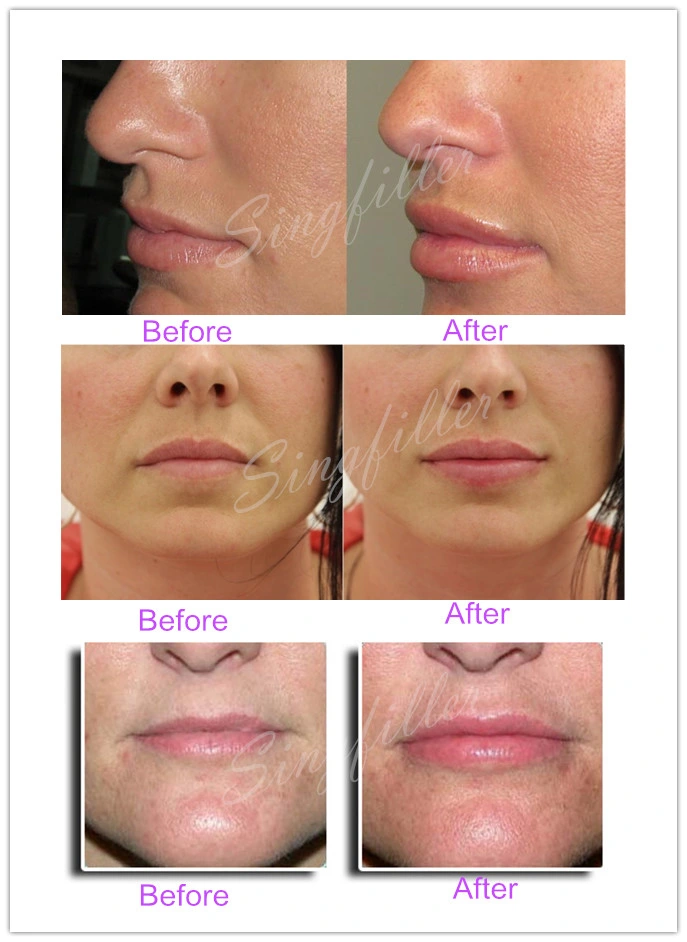 Singfiller Sodium Hyaluronate Dermal Filler for Lips, Cheeks, Breasts, Buttocks