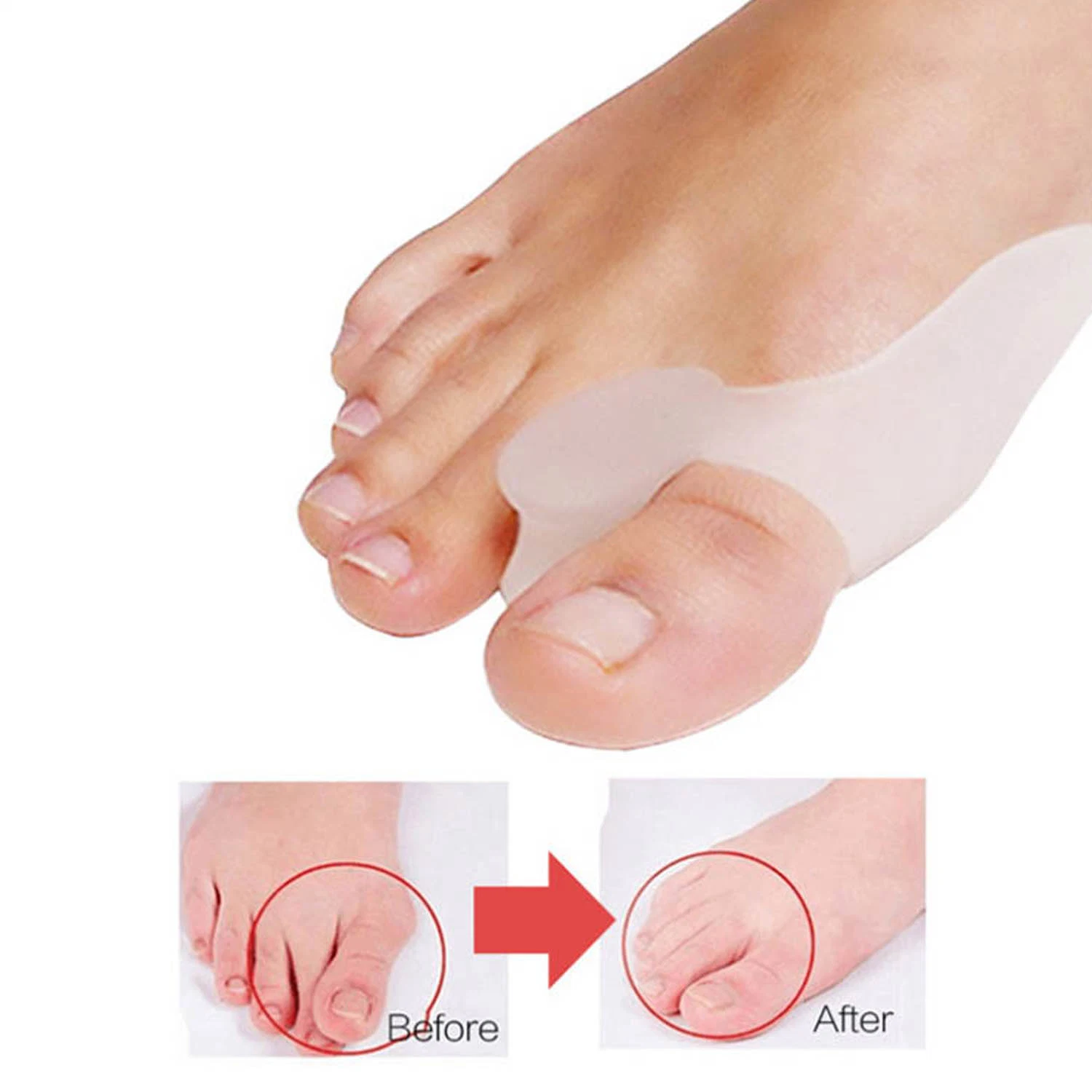 Thumb Valgus Appliance lindern Hallux Valgus Fußschmerzen und lindern Wunde Bunions