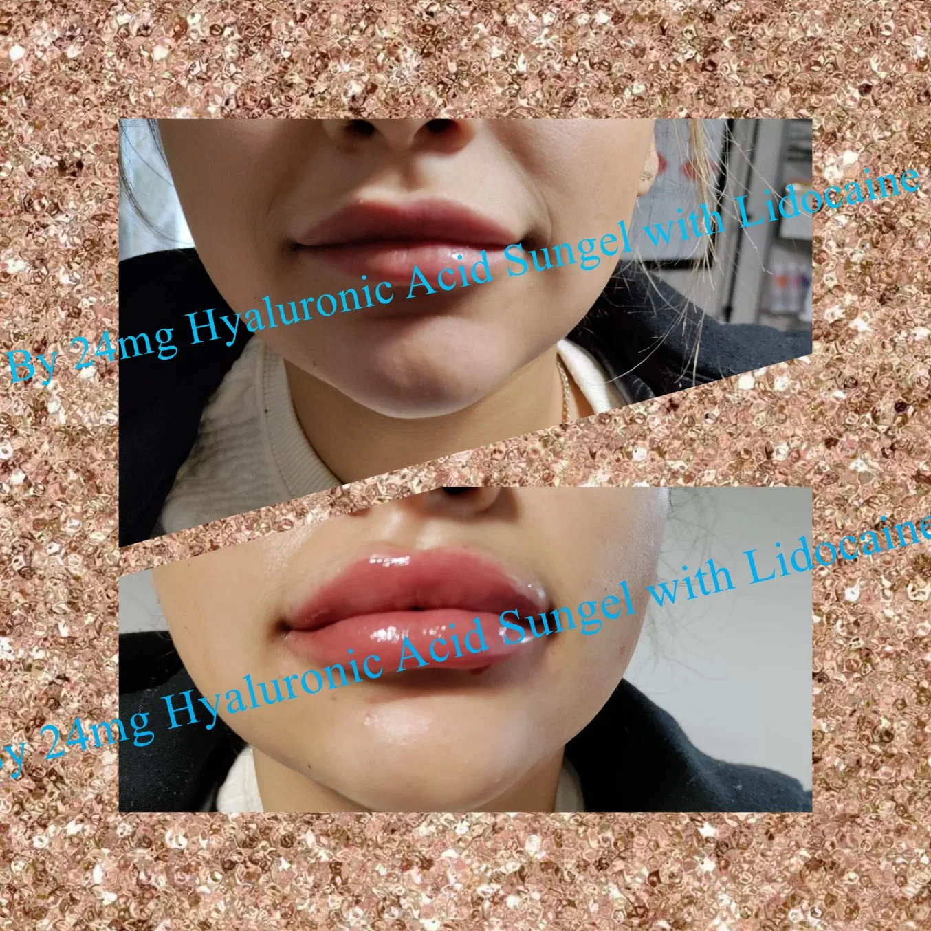 Skin Facial Plastic Injection Wholesale/Supplier Hyaluronic Filler Cross Linked Dermal Lip Correction Filler with Lidocaine