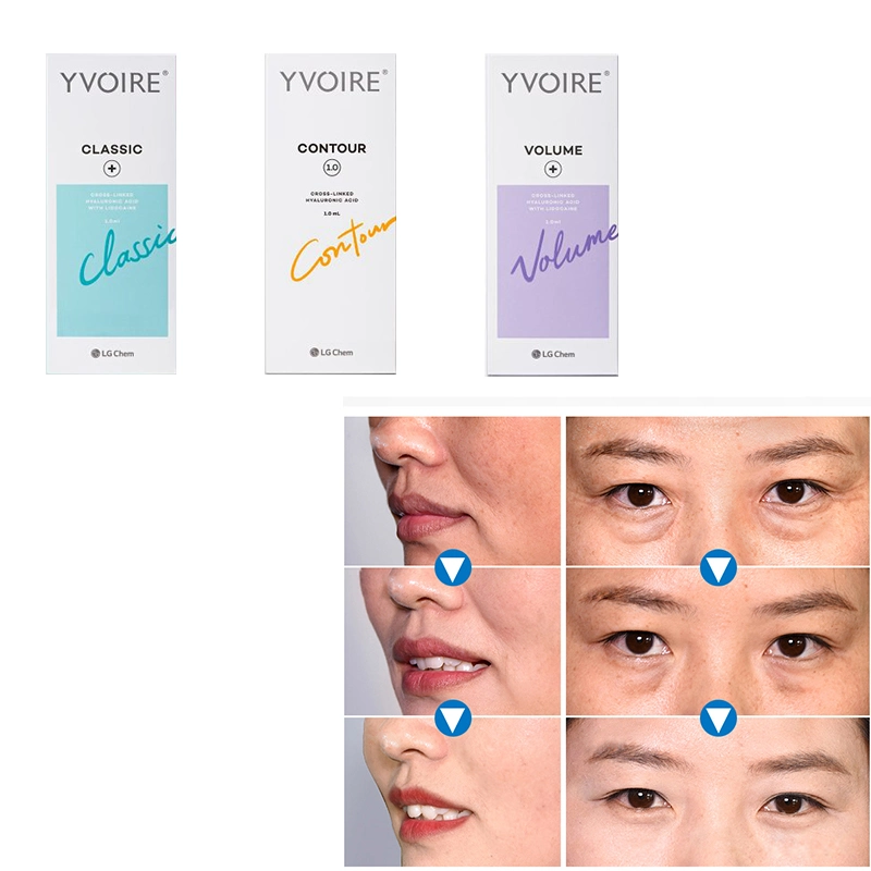 Yvoire Classic / Volume / Contour Injection Modified Sodium Hyaluronate Gel Hyaluronic Acid Dermal Filler Yvoire Neuramis Rejeunesse Dermal Filler