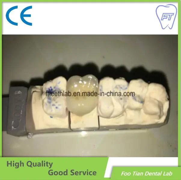 Zahnbehandlung Dental Metal Keramik Krone in Foo Tian gemacht Dental Lab in Shenzhen China