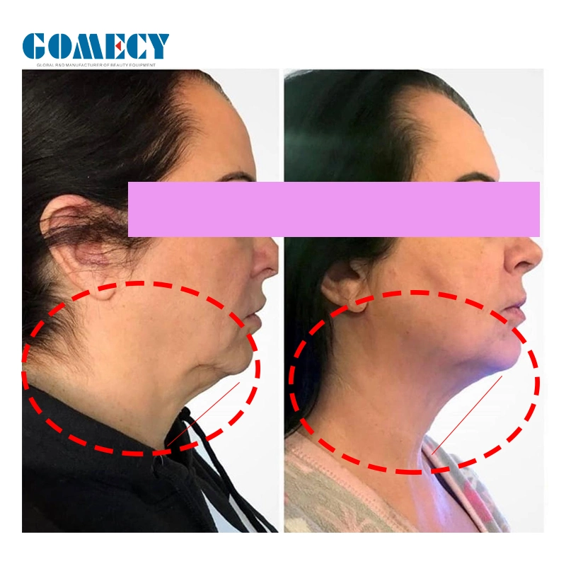 Minimal invasive Laserlipolyse 1470 980nm Medizinische Liposuktion Chirurgische Entdolift Lasermaschine