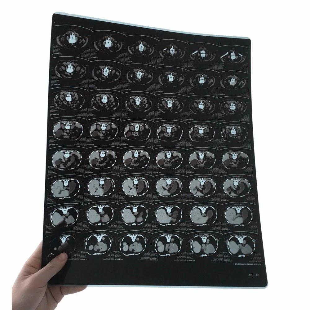 Radiografía de tórax Digital Films/imagen para el Hospital