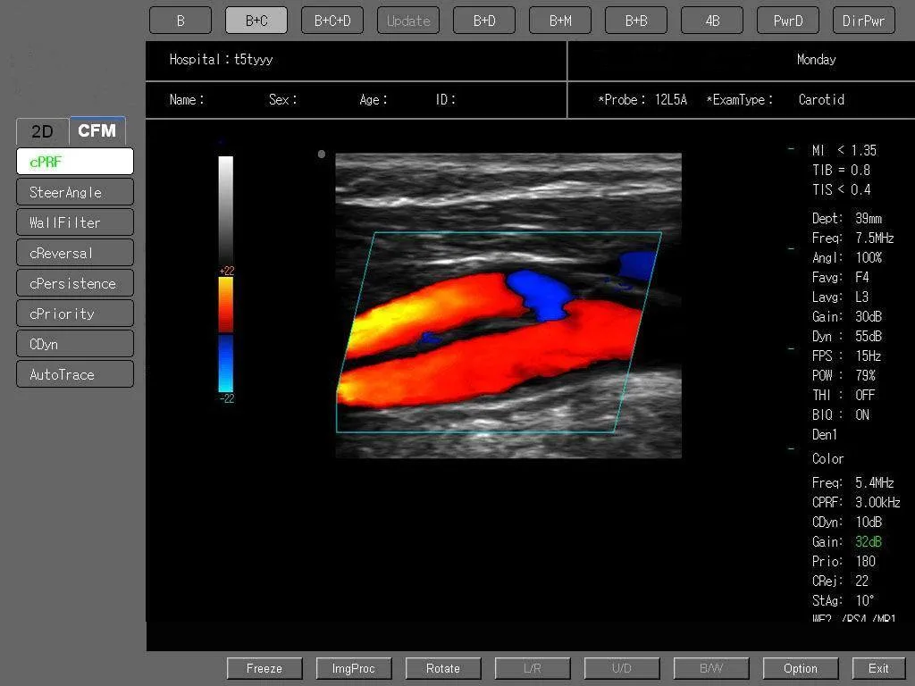 Digital de Instrumentos Médicos Ultrasonido Ultrasonido Escáner Doppler Color