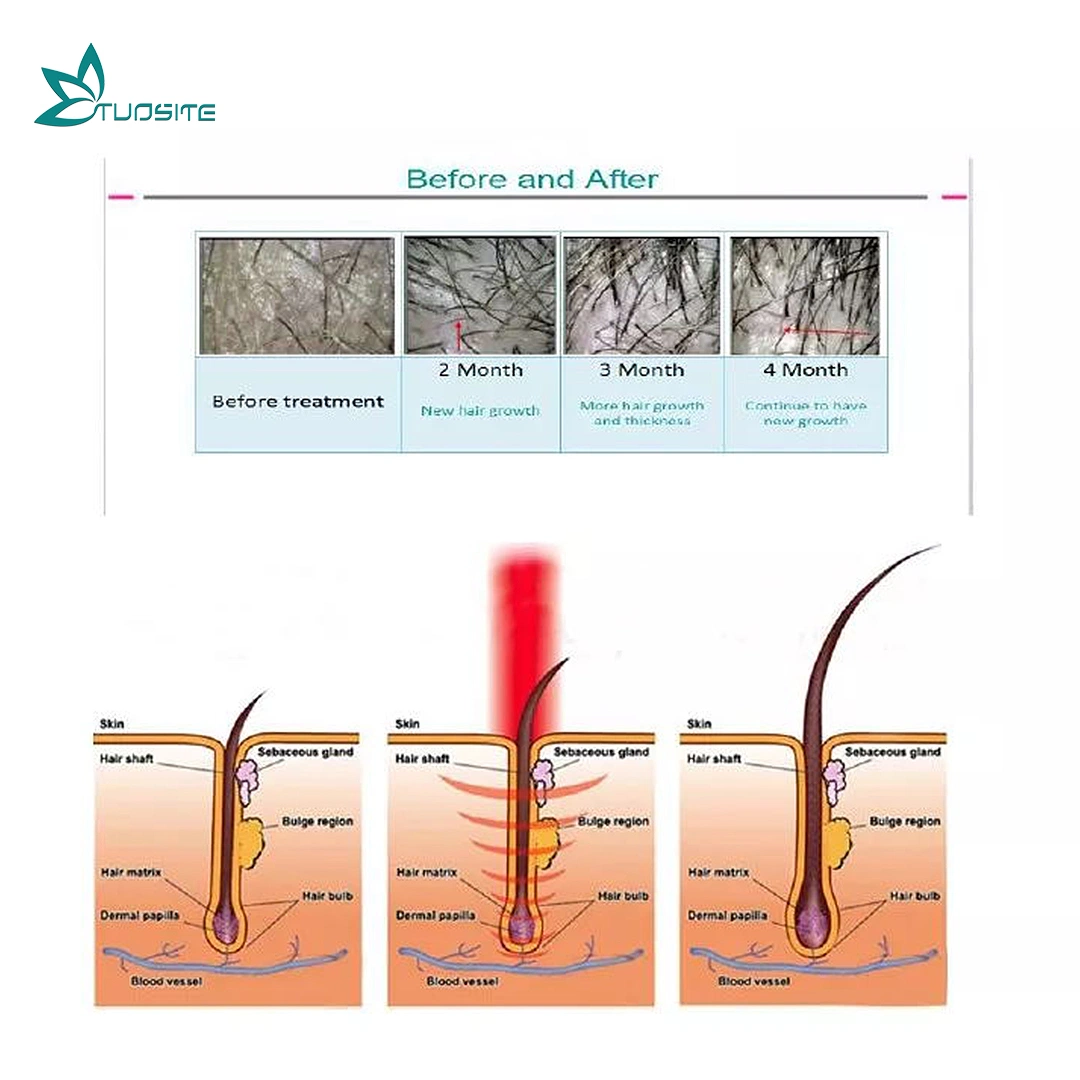 إعادة نمو مضاد لفقدان الشعر alopecia Areata منخفض المستوى ليزر الضوء العلاج لنمو الشعر