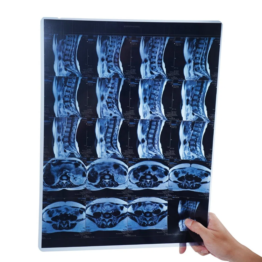 10X12 Inch Blue Dry Thermal Medical Digital Images