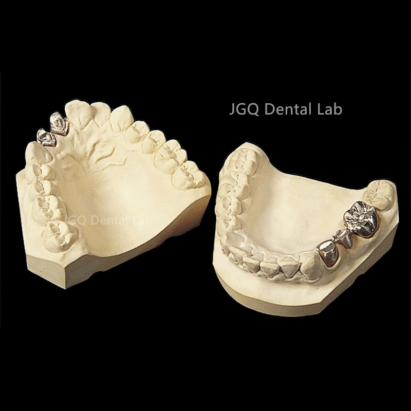 Dentures Teeth Metal Porcelain Ceramic Implant Pfm Crowns and Bridge From China Dental Lab