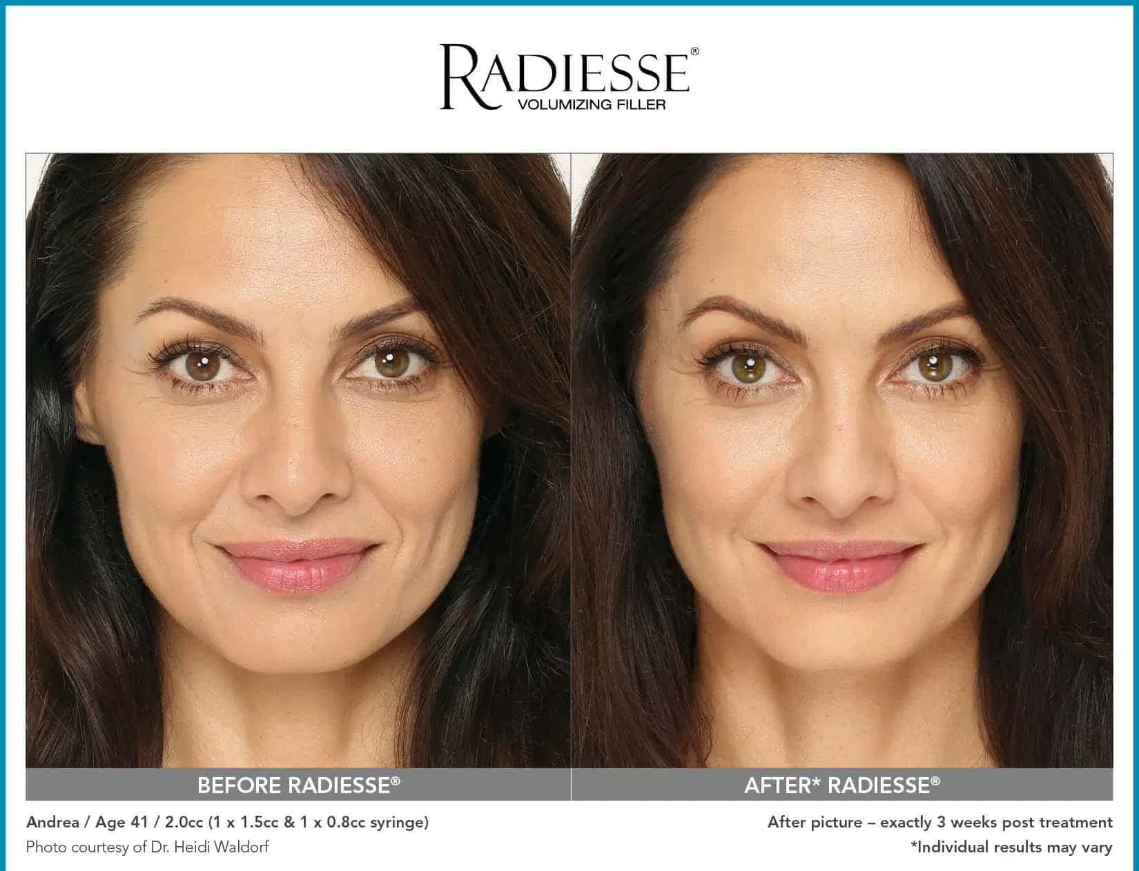 Wholesale/Supplier Radiesse Original Cheek Volume Reduce Anti Wrinkle Treatment Face Lift Injectable Implant Calcium Hydroxyapatite Last Longer Ellanse Sculpta Radiesse