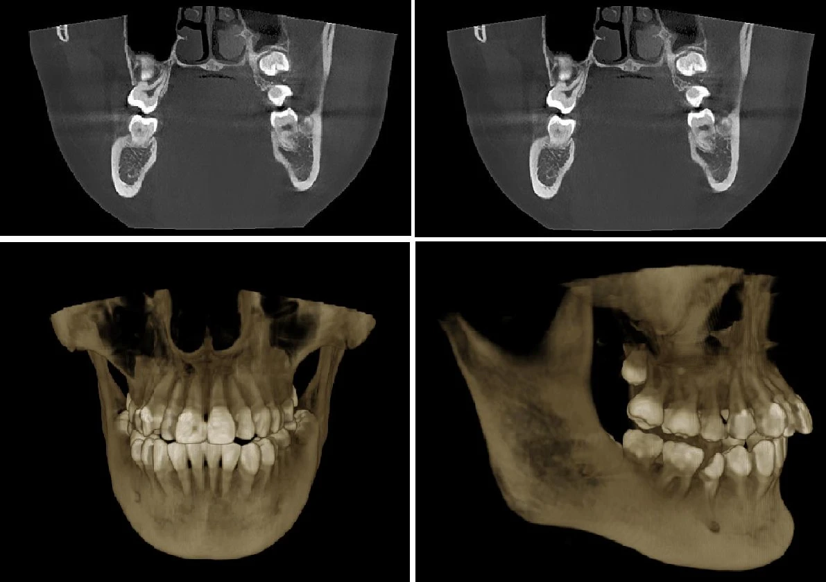 Smart 3D 2D Medical cefalométrico panorámico digital Dental Cbct Dispositivo de rayos X para diagnóstico con certificado CE Dental