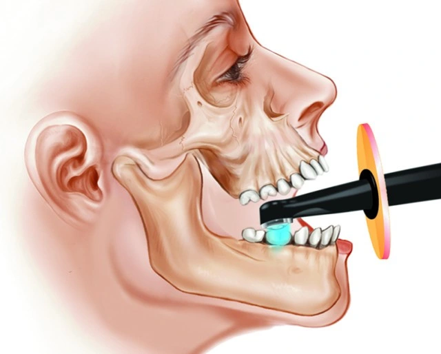 O LED Wireless LED Wrie Cura Banheira de venda a cargo o funcionamento silencioso e sem fio dental de cura de LED Light