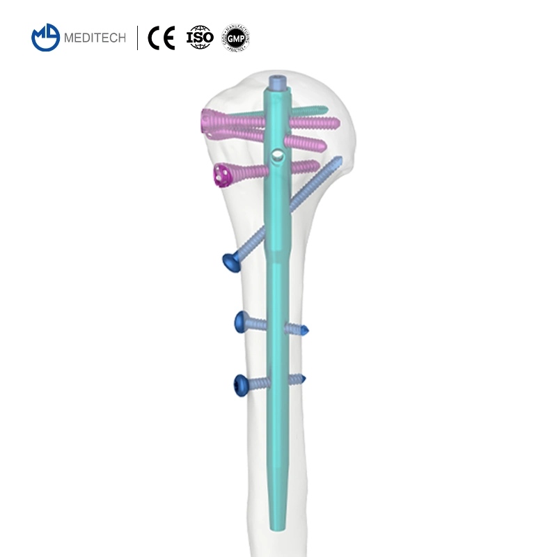 Fabricants chinois de clous intramédullaires Multi-Lock pour la chirurgie des implants orthopédiques.