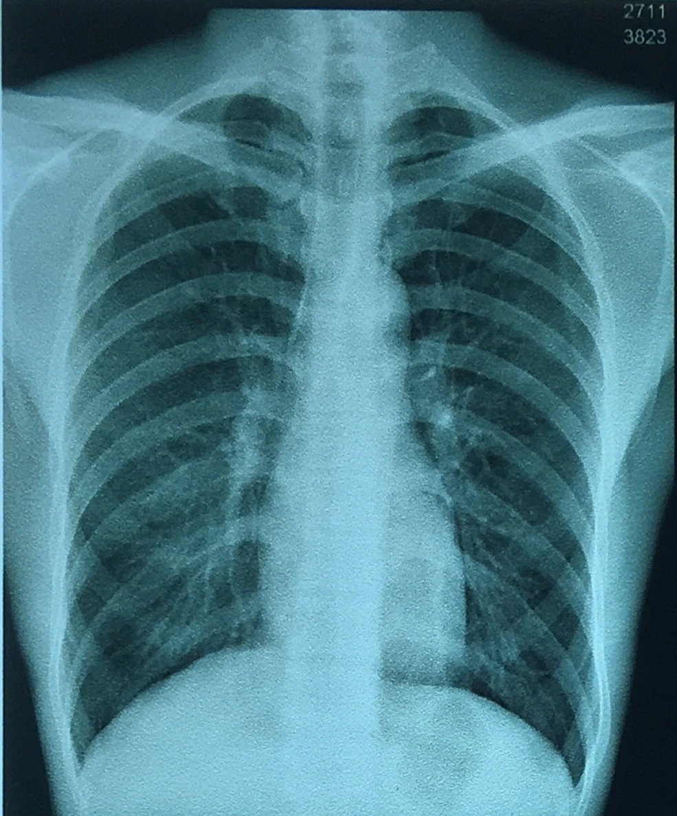 Röntgenfilme der digitalen Thorax, blaues Bild