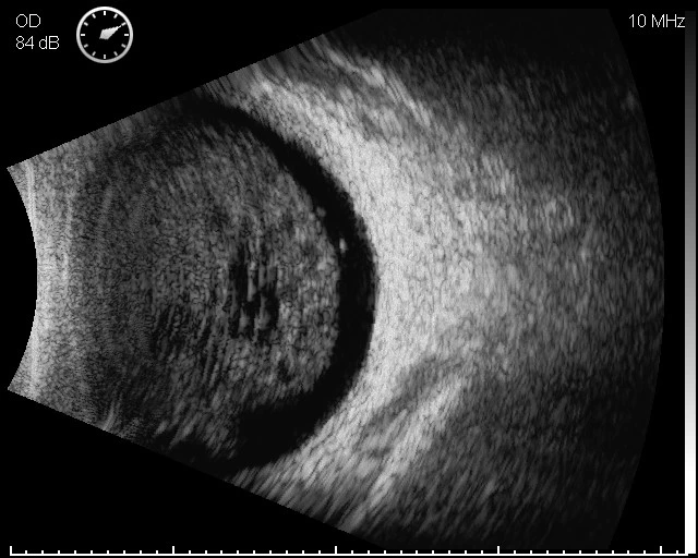 High quality/High cost performance Economic Ultrasound a/B Scan for Ophthalmology (ODM-2100S)