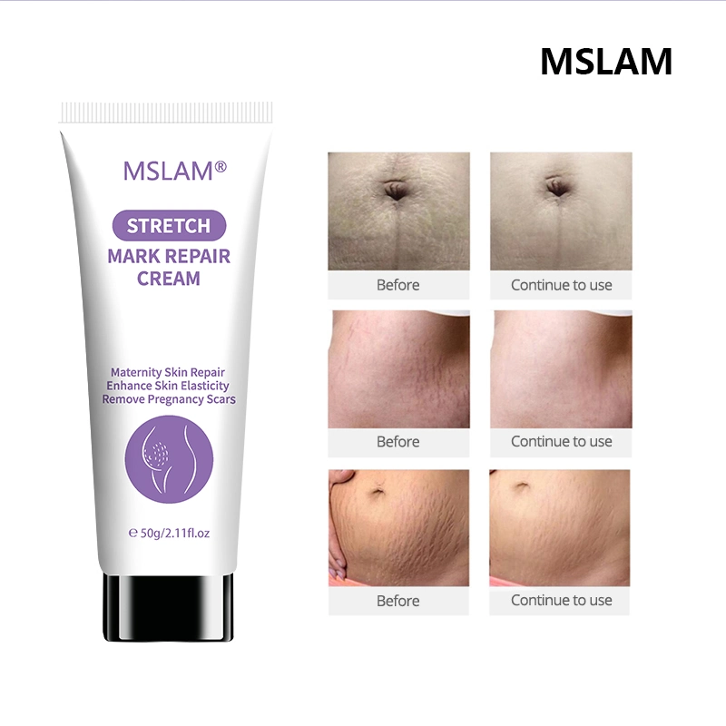 Crème pour le corps de la peau précieux Mslam Vergetures Remover Scar dépose post-partum puissant de l'Obésité Grossesse Cream 50ml