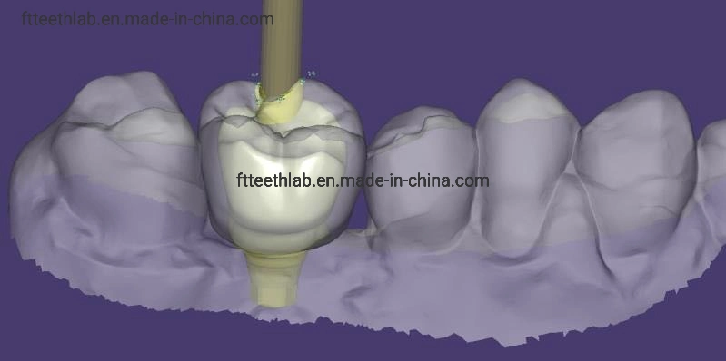 Full Arch Implant Bridge Made with 3D Scan Files Dental Implants