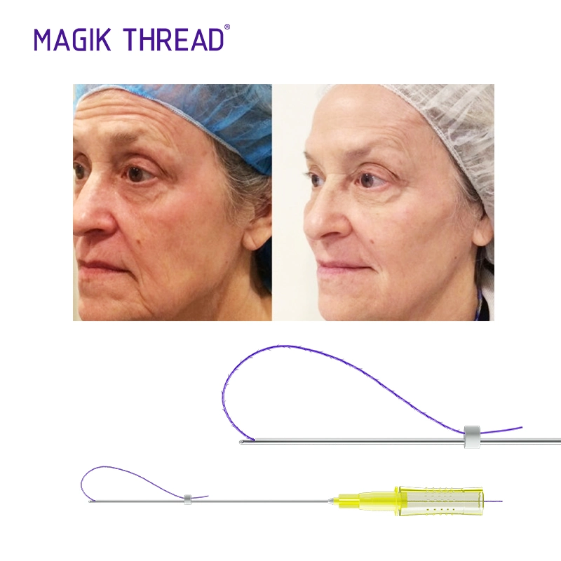 Facelift Products Pdo Threads Under Eyes 3D 4D 6D Cog Lift Pdo Meso Threads