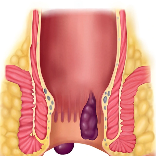 Laser Treatment for Hemorrhoids Diode Laser 980+1470nm Proctology Haemorrhoids Cutting Hemorrhoids Treatment Device