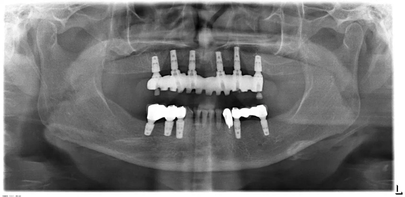 Angels Knochenebene Implantatlinie mit Titan GR5 Zahnimplantat Implantate Auf Knochenebene