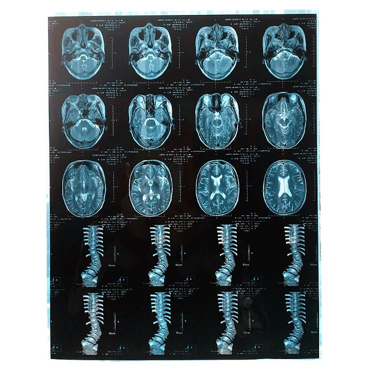 Resonancia magnética médica de la película azul seco Agfa FUJI Drypix Precio máquina de rayos x