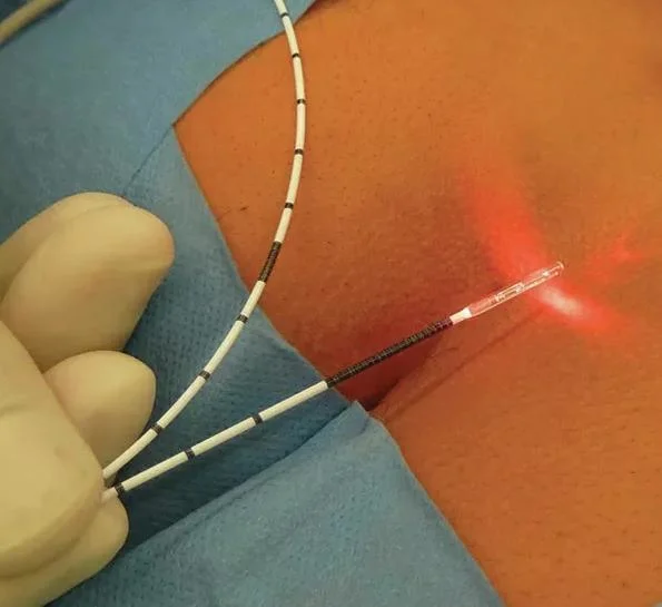 A mais recente fenda de fístula anal Hemorrhoids de 980 nm do laser de díodo 1470 nm Tratamento de Pilonidalis sinusal Proctologia instrumento Laser cirúrgico