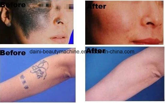 Specialized in Tattoo Removal Q Switch ND YAG Medical Laser Korea