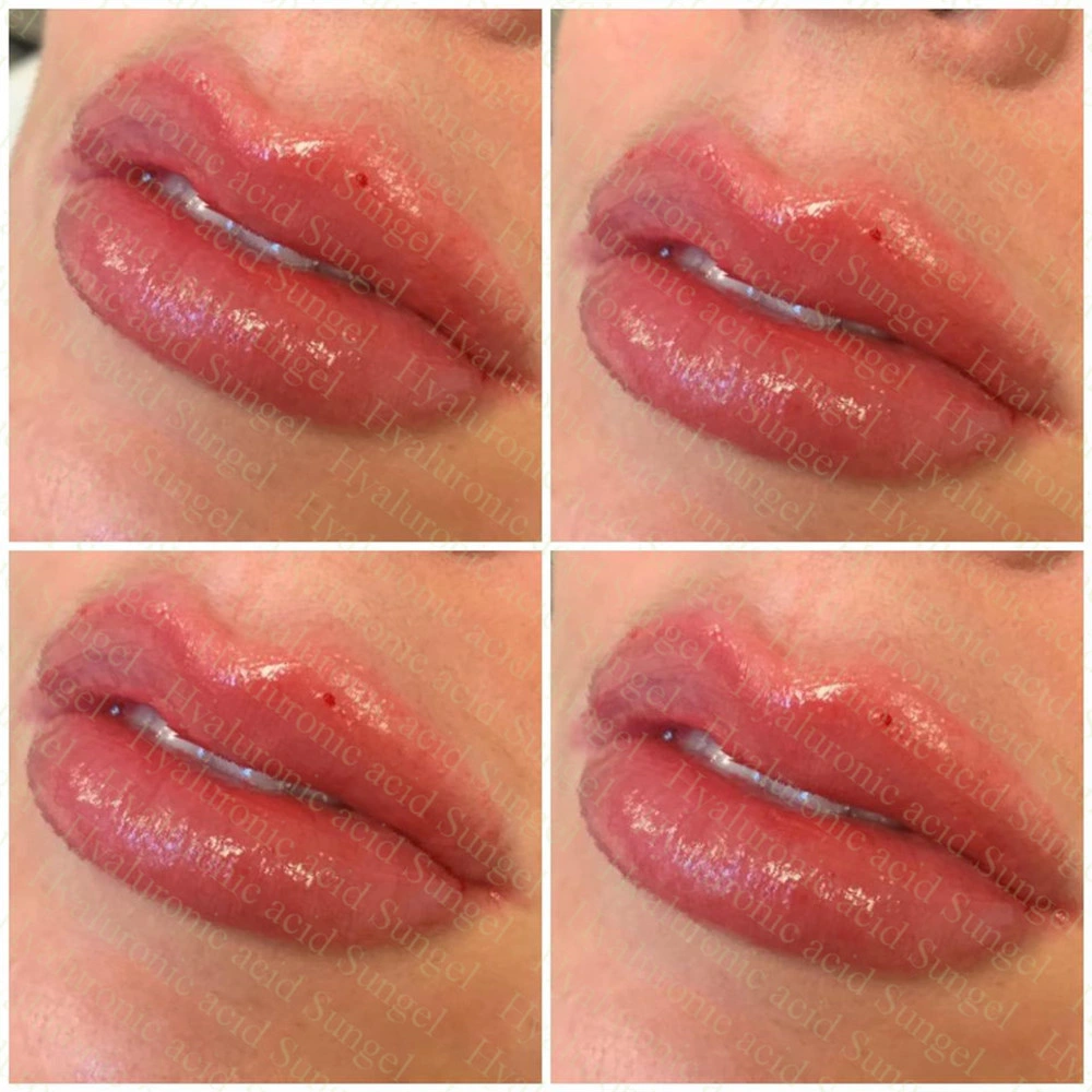 2ml Hyaluronic Acid Sunfiller Injectable Dermal Filler for Lip Fullness