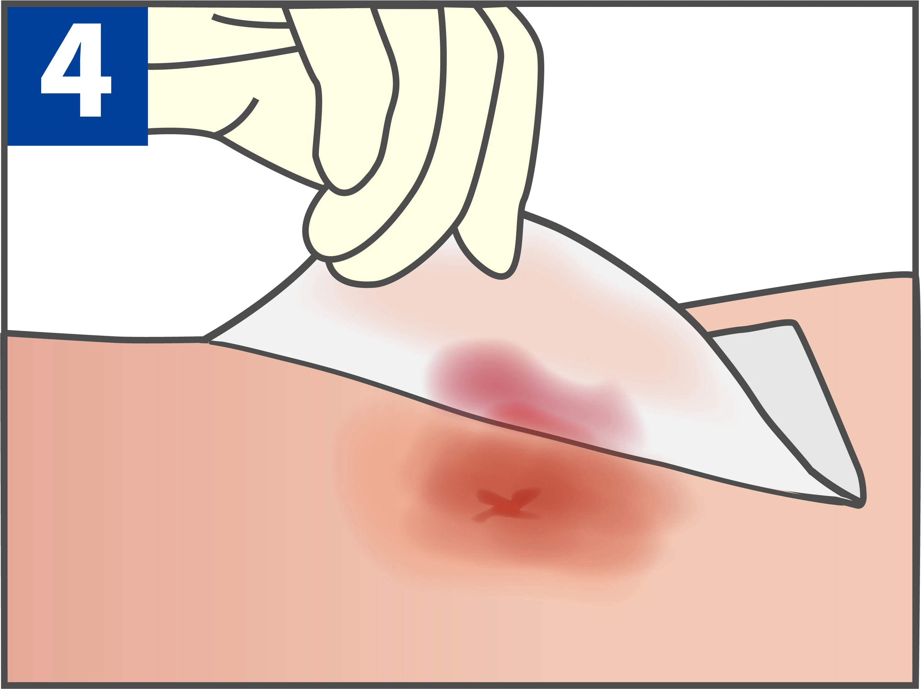 Disposable Medical Sterile Dressing with Low Dressing Change Injury