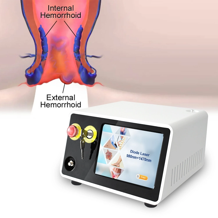 980nm 1470nm pilas de hemorroides fístula ablación con láser Proctología Anorrectal con láser Láser de hemorroides en Proctología tratamiento de hemorroides con láser quirúrgico anorrectal