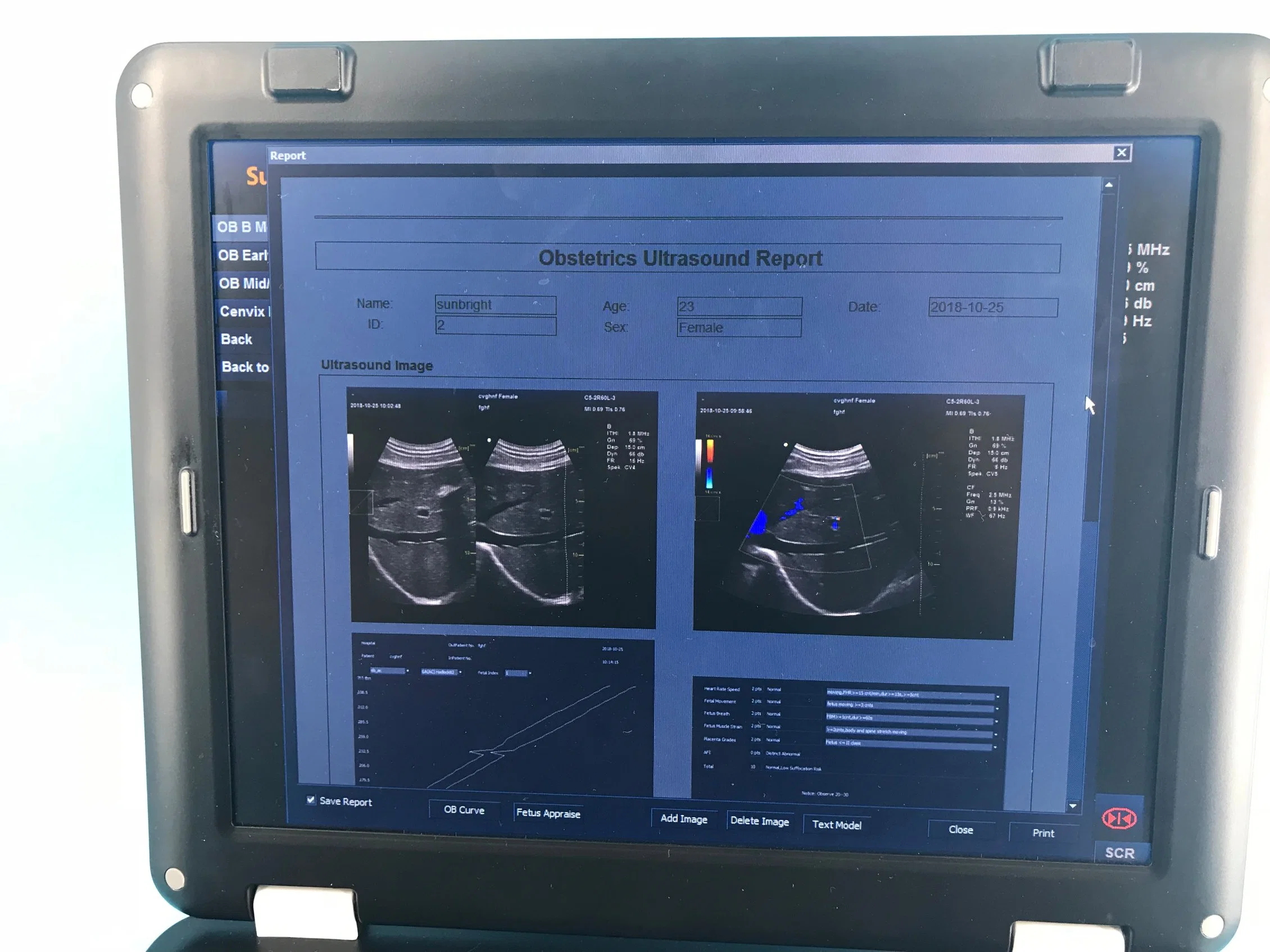 15 Inch Pw Auto Trace Measurement Color Doppler Ultrasound Medical Scanner