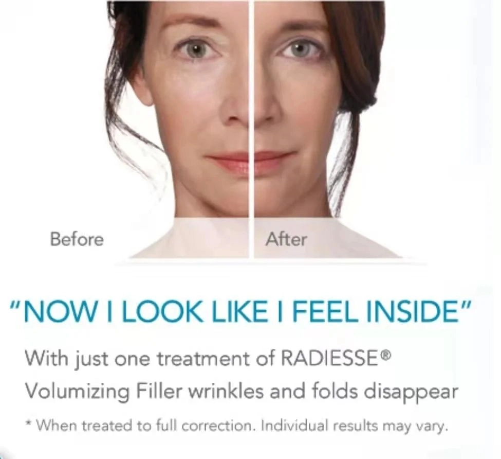 Geben Sie Radiesse Calcium Hydroxyapatit Filler Injizierbare Dermal Filler Skin Booster Für Anti-Aging und Faltenentfernung Lumi Augen Rejeunesse Revolax Eptq