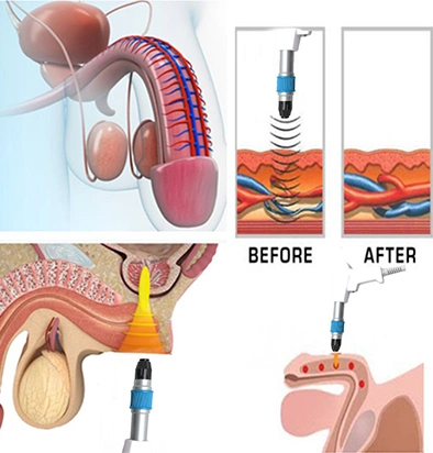 Neues Design Leistungsstarke Erektile Dysfunktion Shockwave Therapie Maschine