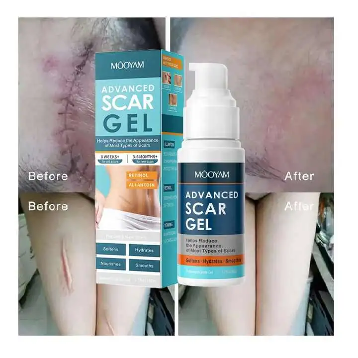 Advanced Scar Gel Scar Removal Gel Helps Reduce All Types Scar