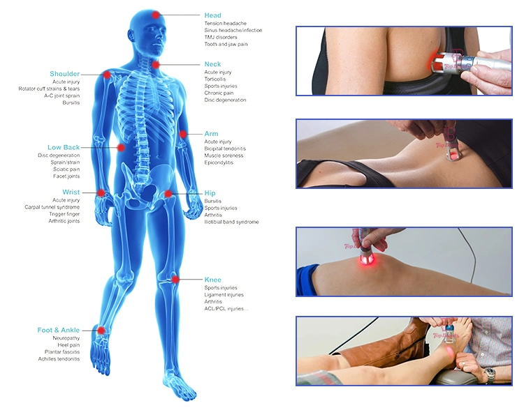 Cold Laser Lllt-808 Red Light Therapy Treatment for Rheumatic Pain Relief Sport Injuries