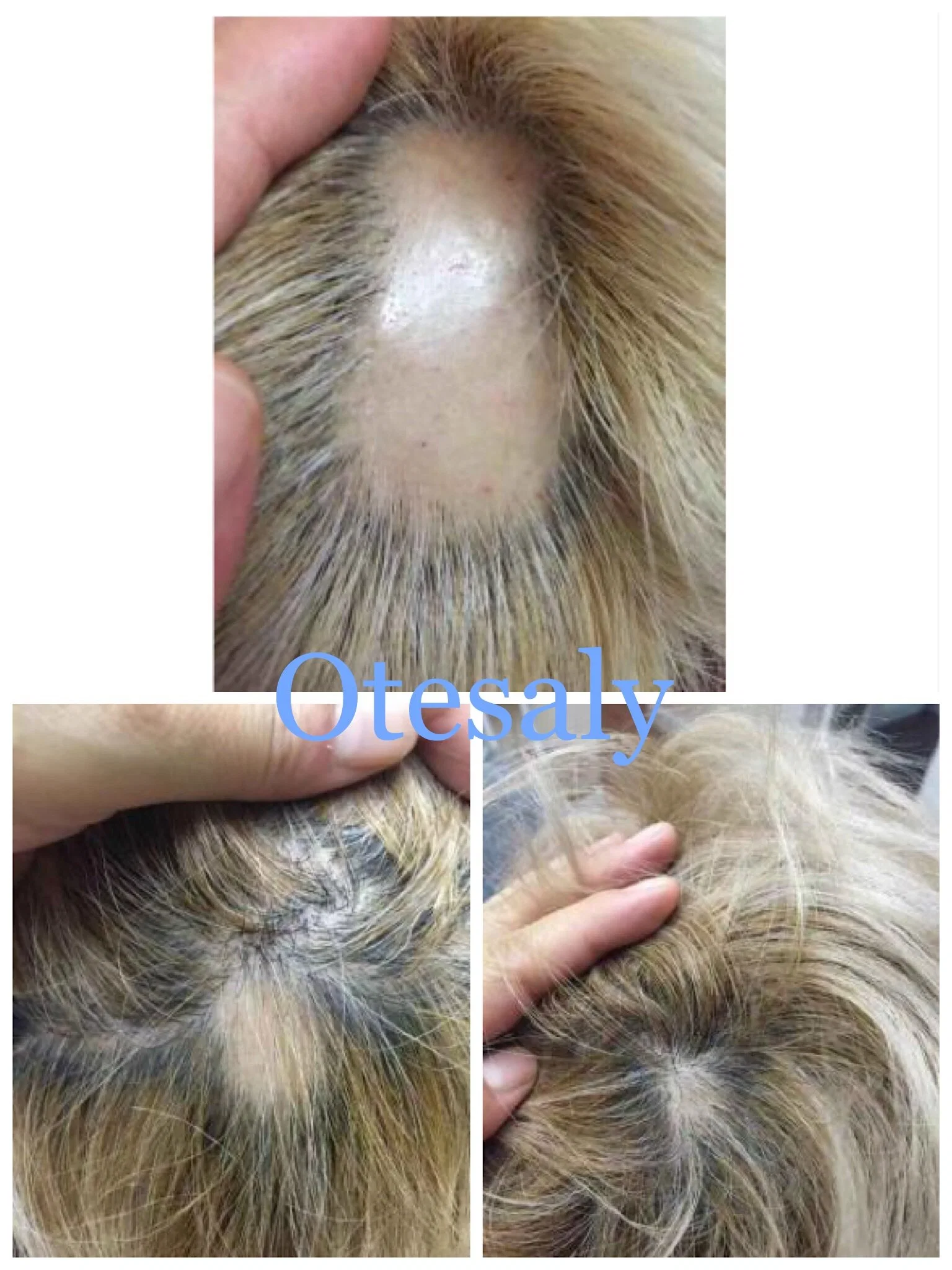 Hot Selling Top Quality Otesaly Anti Hair Loss Serum Scal Nourishing Mesotherapy Treatment Meso Solution