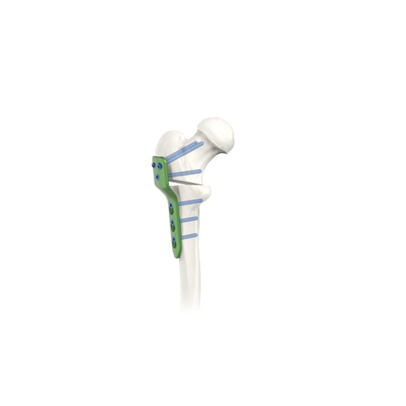 Orthopedic Implant Pediatric Osteotomy Locking Plate with CE