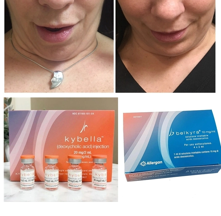 Kybella Allergan Belkyra Fat Dissolver Results Swelling for Double Chin Reduction Nom-Surgical Neck Fat Loss Weight Injection Kabelline Lemonbottle Ozempics