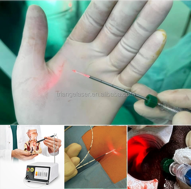 980+1470nm Diode Soft Tissue Cutting Hemorrhoids Removal Laser