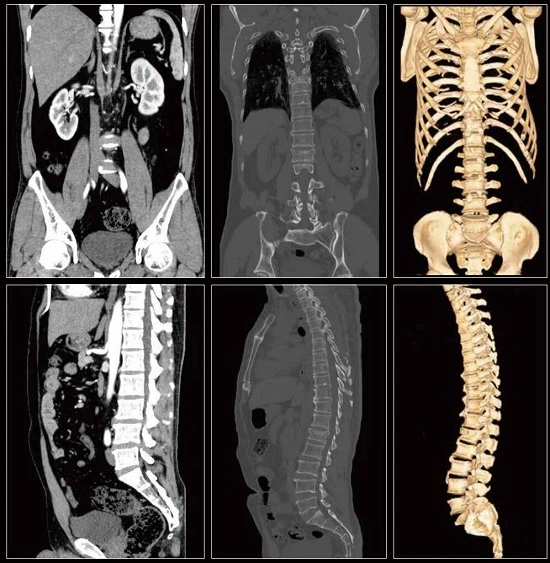 32-Slice CT Scanner (ScintCareBlue 755)