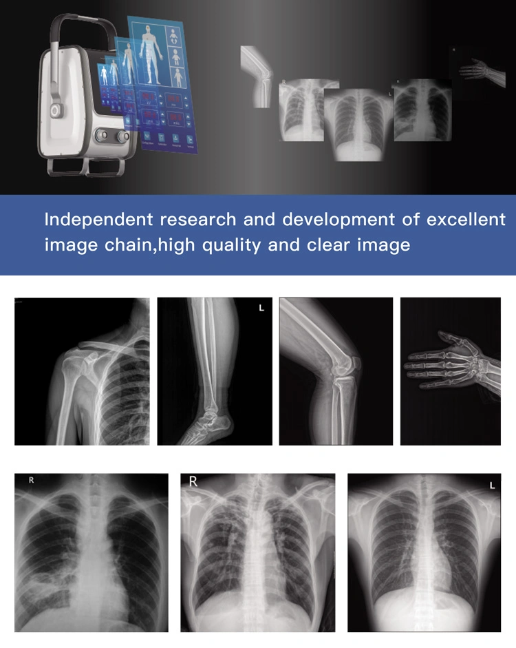 My-D019f Medical Device China X-ray Dr System Machine Digital Portable X-ray Unit